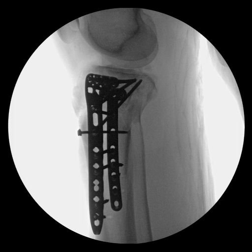 What’s the worst injury case you handled?