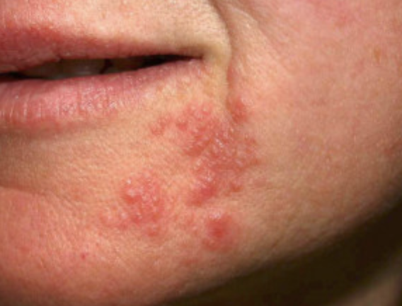 Eksempel på hvordan perioral dermatitt kan fortone seg