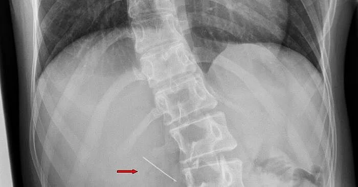 Needle removed from a 17-year-old girl’s stomach