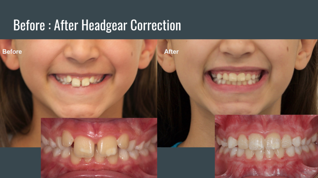 Clinical Spotlight: Headgear — Tri-ortho.com Clinical Spotlight: Headgear — Tri-ortho.com