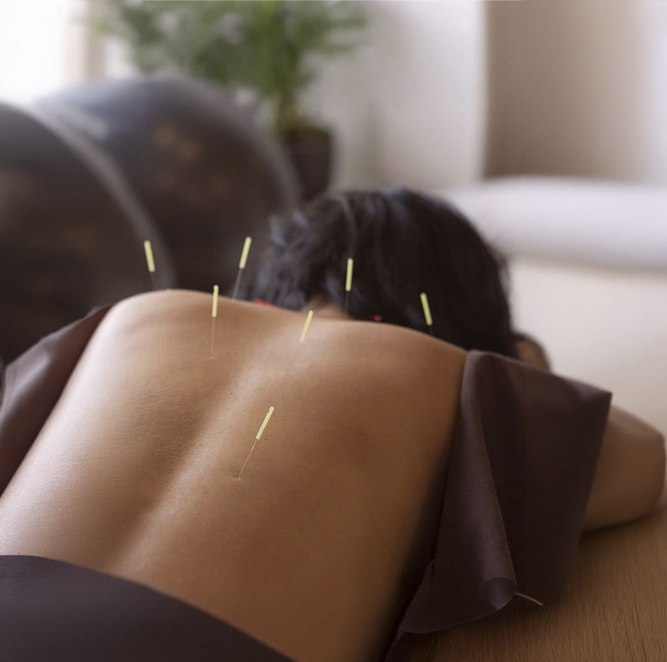 Homepage-acupuncture.png