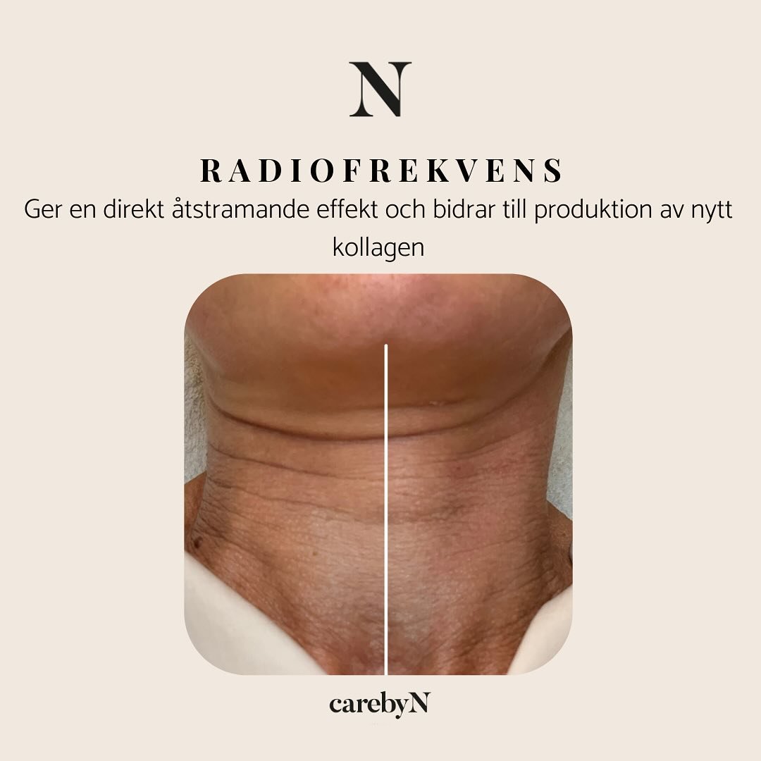 Radiofrekvens-
H&auml;r jobbar radiov&aring;gor 3 millimeter ner i huden f&ouml;r att bilda nya kollagenfiber vilket &auml;r den viktigaste best&aring;ndsdelen f&ouml;r en stram och sl&auml;t hy.
Under behandlingen slussas ett sm&aring;molekyl&auml;r