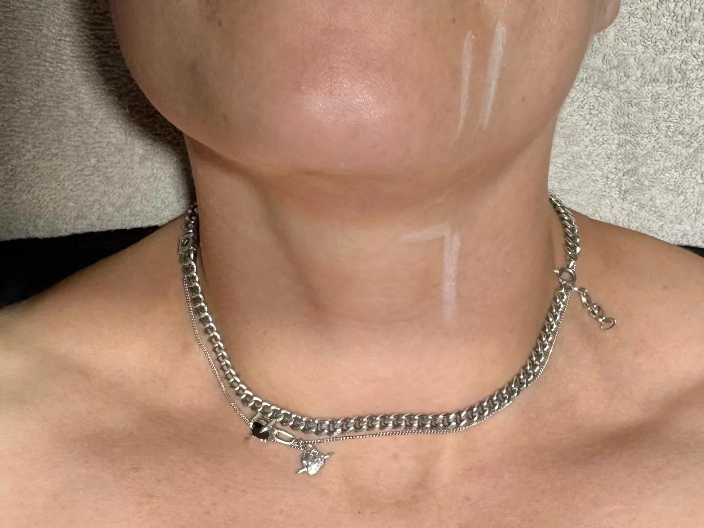 H&auml;r har vi anv&auml;nt ultraljud (HIFU) f&ouml;r att strama upp huden l&auml;ngs k&auml;klinjen.
Den v&auml;nstra sidan &auml;r nybehandlad, medan den h&ouml;gra sidan &auml;r obehandlad.
Redan h&auml;r ser man den omedelbara uppstramande effekt