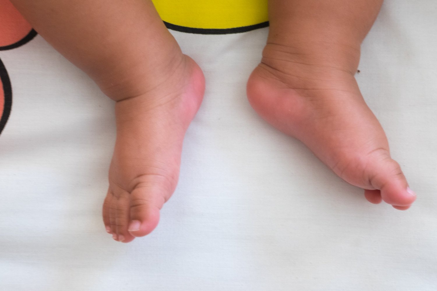 InToeing & OutToeing Treatments — FOOT & ANKLE CENTERS