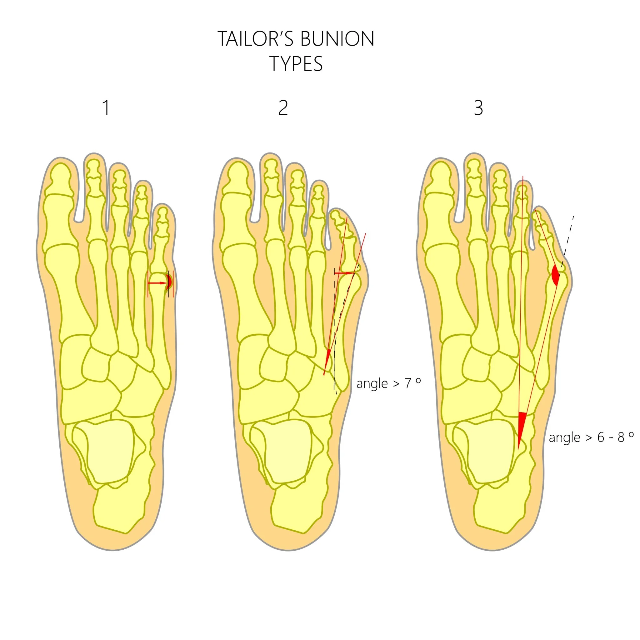 Foot Ache Meaning At Peggy Rios Blog