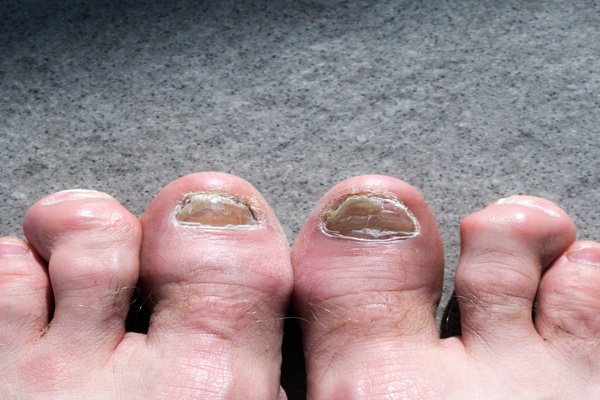 YX STORE 10ml/20ml/30ml Anti Fungus Liquid Toe Finger Nail Infection Repair  Treatment - Walmart.com