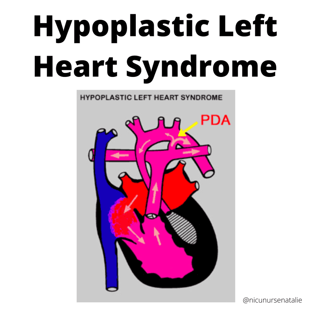 Hypoplastic Left Heart Syndrome (HLHS) — THE NURSE NATALIE