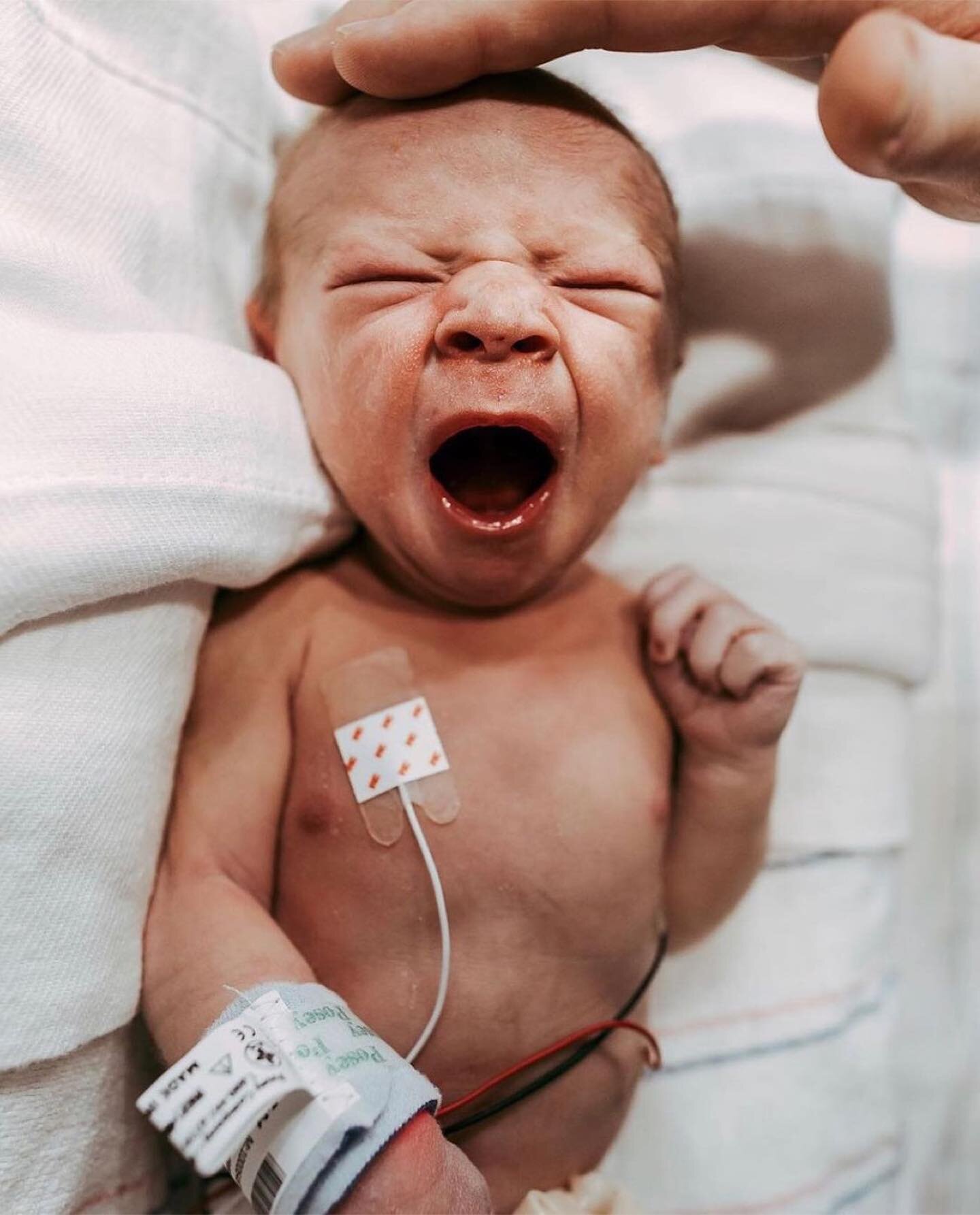 NICU common diagnoses 👶🏽🩺💗

Level 3 &amp; 4 NICUs see a wide range of admissions! Prematurity is usually what you think about regarding the neonatal intensive care unit, but there are so many reasons an infant might need special care including bi