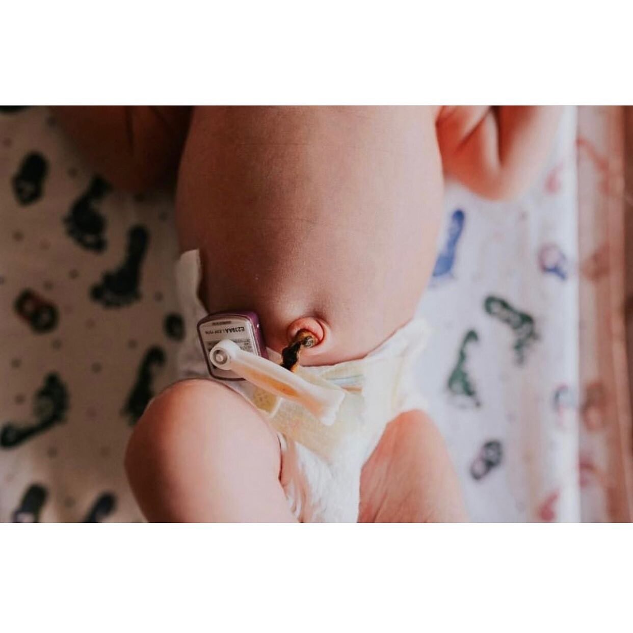 How to Care for a Newborn's Umbilical Cord ✨❤️

The umbilical cord is truly an incredible thing. It's the life-line that carries important nutrients and blood from the mother to the baby.⁠ 🪢

✂️ At birth, the umbilical cord is clamped and cut - leav