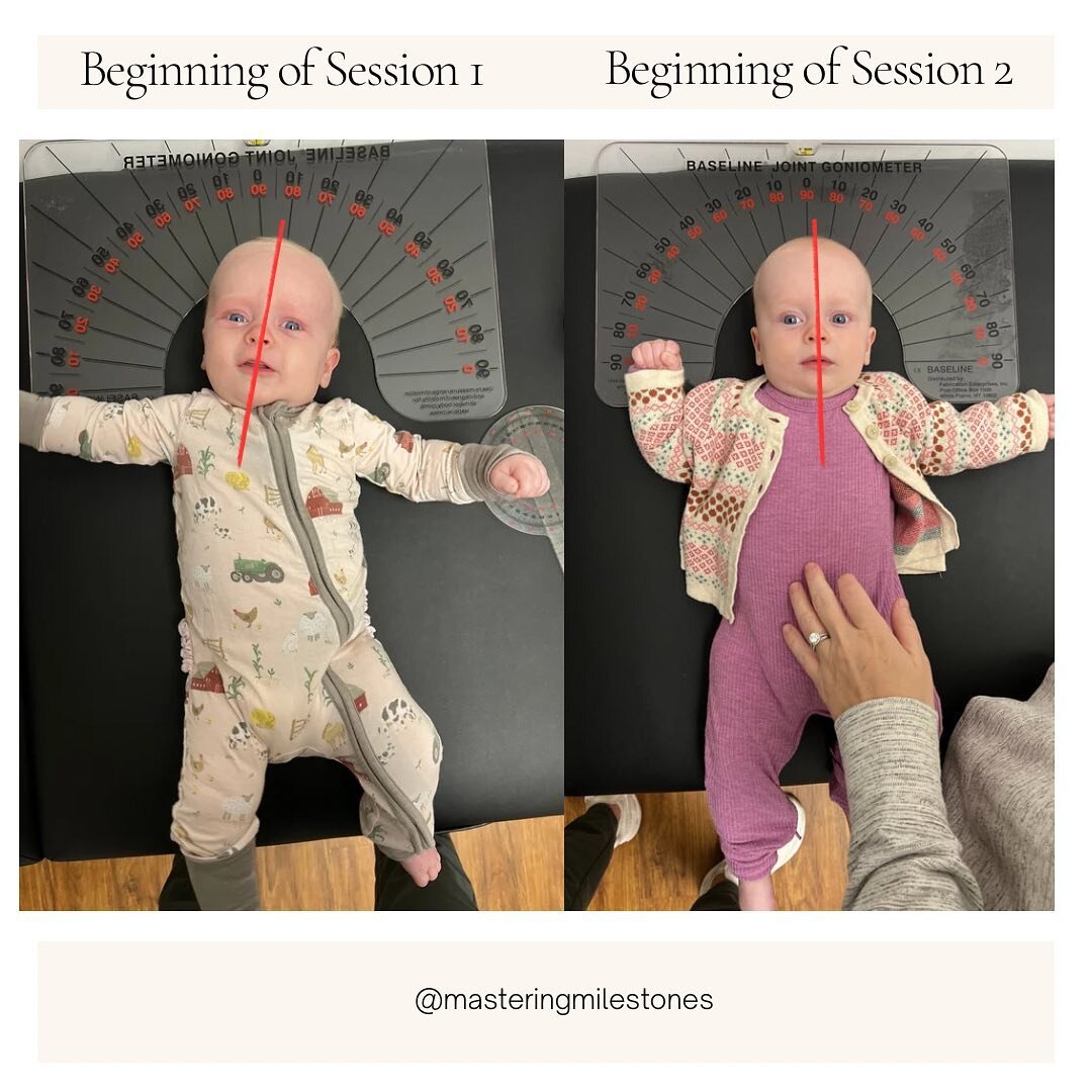 Baby referred with primary concern for mild Plagiocephaly. After one session Mom reported baby slept better, is turning her head more in both directions when awake and asleep, is attempting to roll over, is much more comfortable and starting to fall 