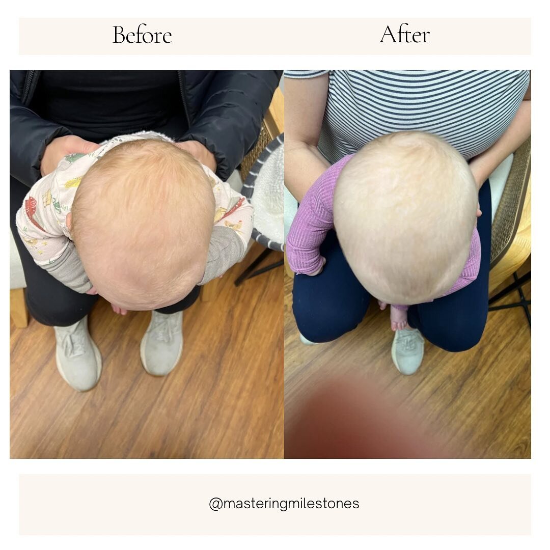 Baby referred for Plagiocephaly. Caregiver had been consistent with a positioning protocol which was received through a virtual consult with an out-of-state provider. Mom reported an improvement in overall head shape initially with the positioning pr