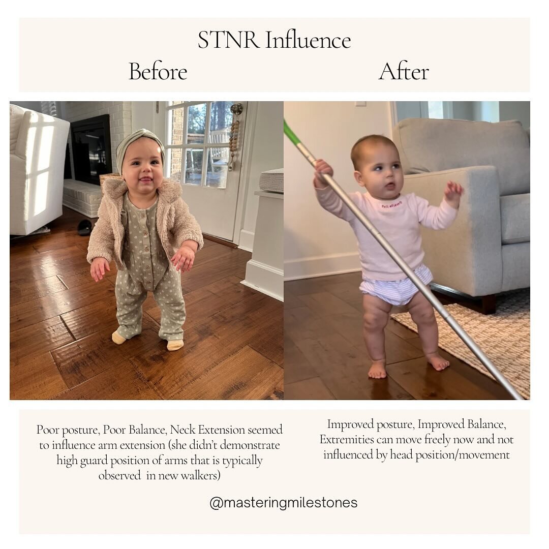 Symmetrical Tonic Neck Reflex (STNR) is a transitional reflex that is active from 6-10th month of an infants life. Head flexion causes arms to bend &amp; legs to extend. Head extension causes arm extension &amp; leg flexion. It assists baby with gett
