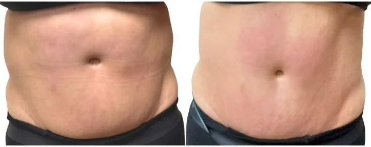 Non-Invasive Body Contouring: A Relaxing Alternative To Invasive/Surgical Procedures