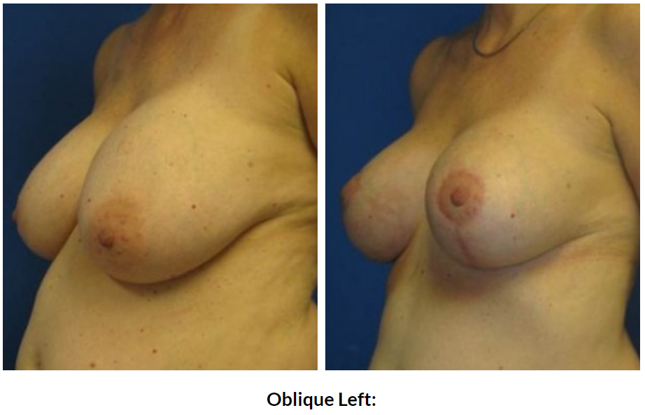 0337 oblique left.PNG