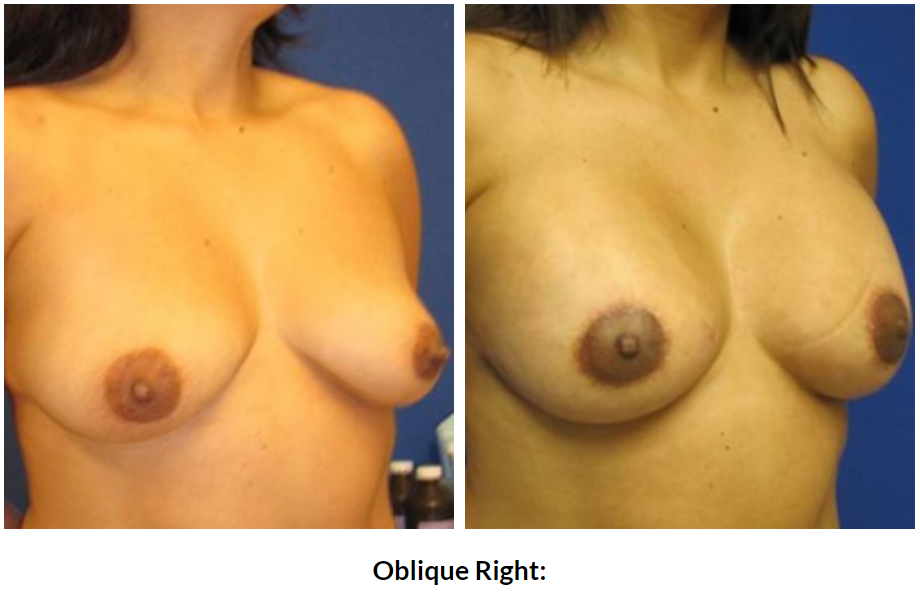 0334 oblique right.PNG