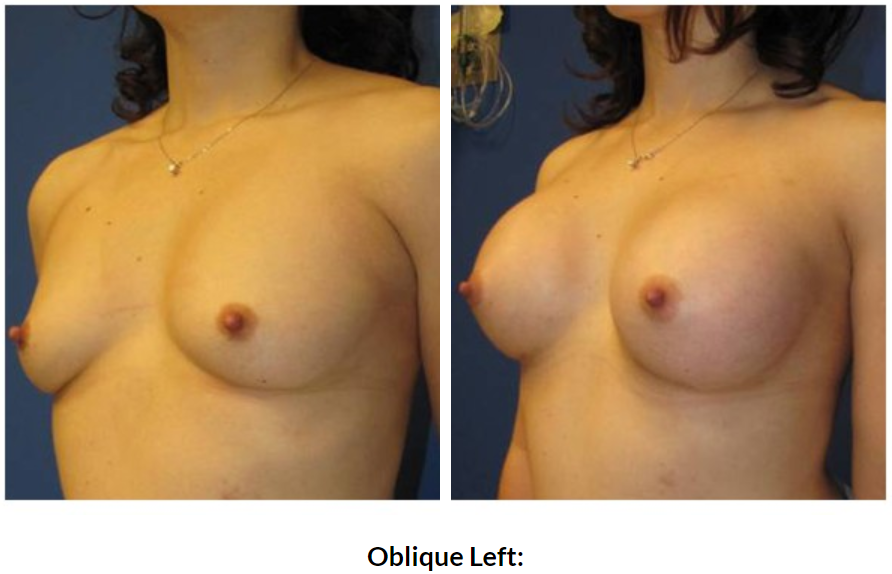 0395 oblique left.PNG