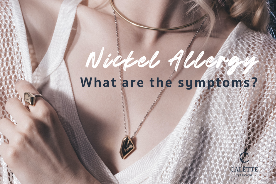 Nickel Allergy in Jewelry: What are the symptoms?