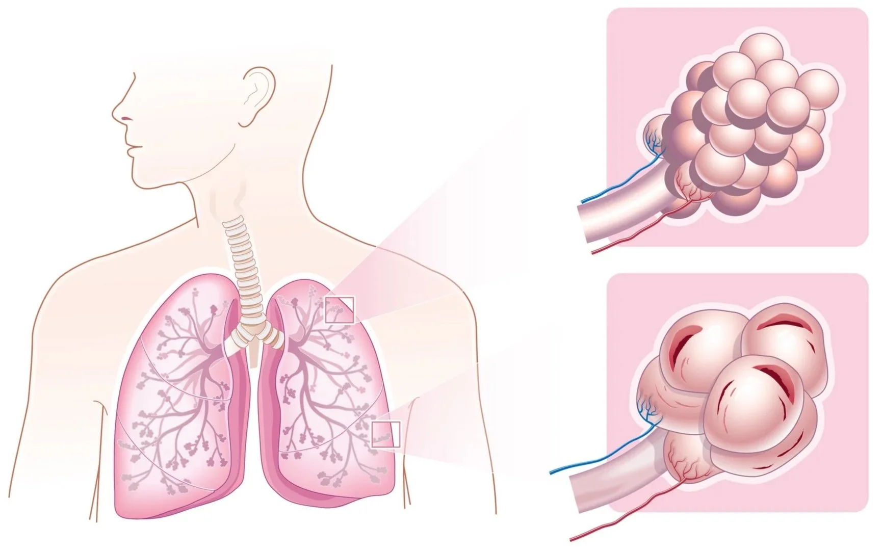 medicinsk illustration, kol, lungor, hjärtlungfonden