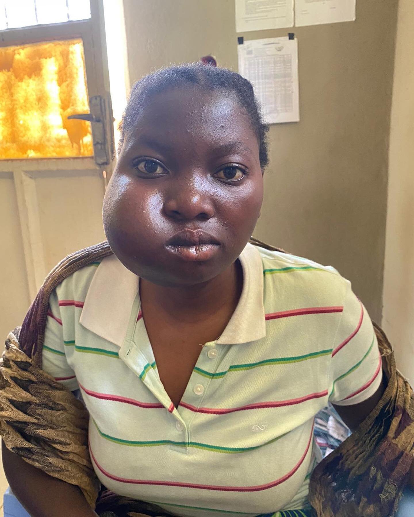 A $50 donation makes a life-changing difference! Sarah arrived at our latest medical mission in Minova with a giant tumor on her cheek. After an evaluation, the team decided we could help! Fast forward one week and Sarah is on the mend, very happy, a