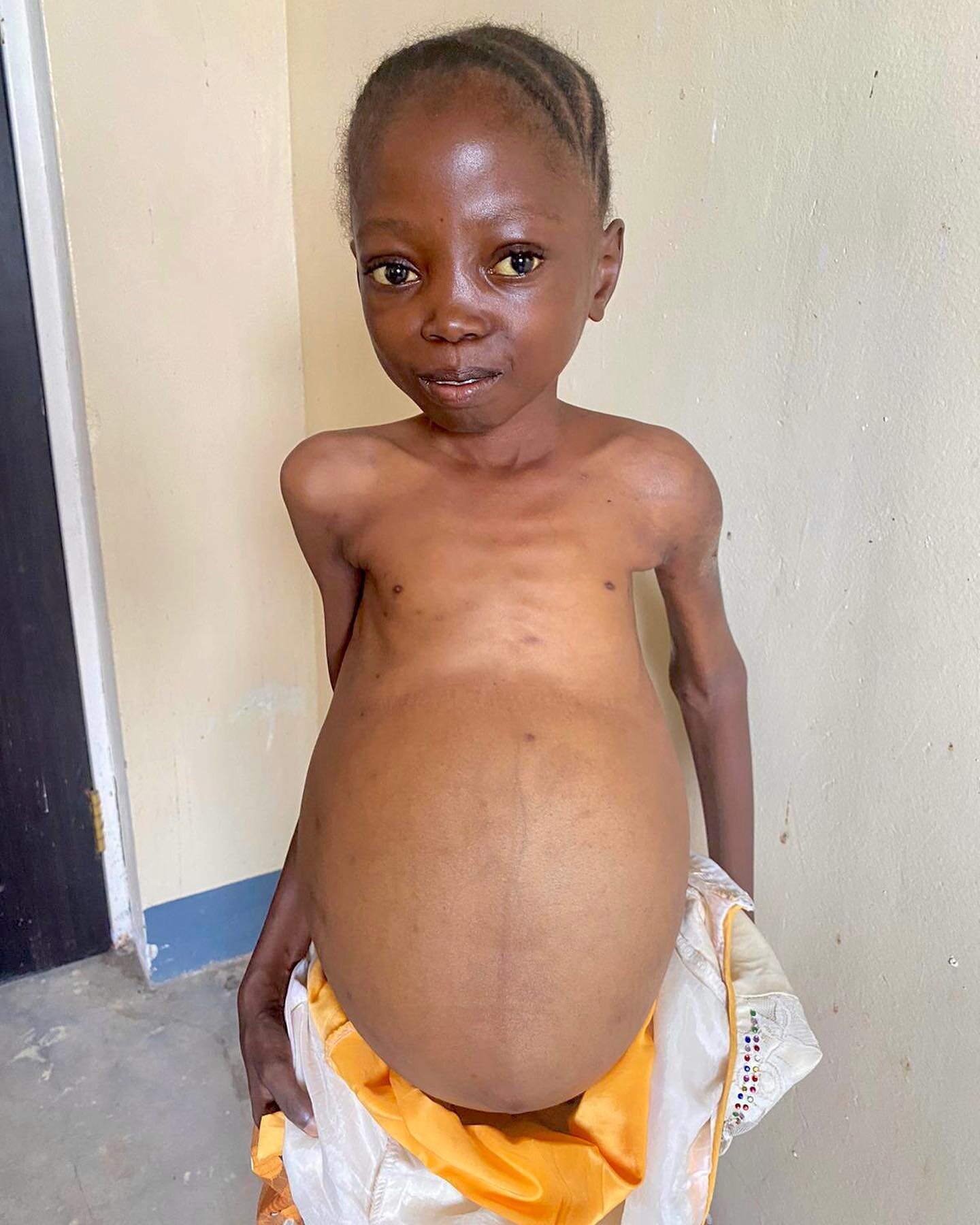 From suffering to joy💕

Demaman suffers from an enlarged spleen due to numerous bouts of malaria and infection. After a two-hour surgery, the Upright Africa team successfully removed her 8-pound spleen, giving her body a much-needed reprieve. 

Dema