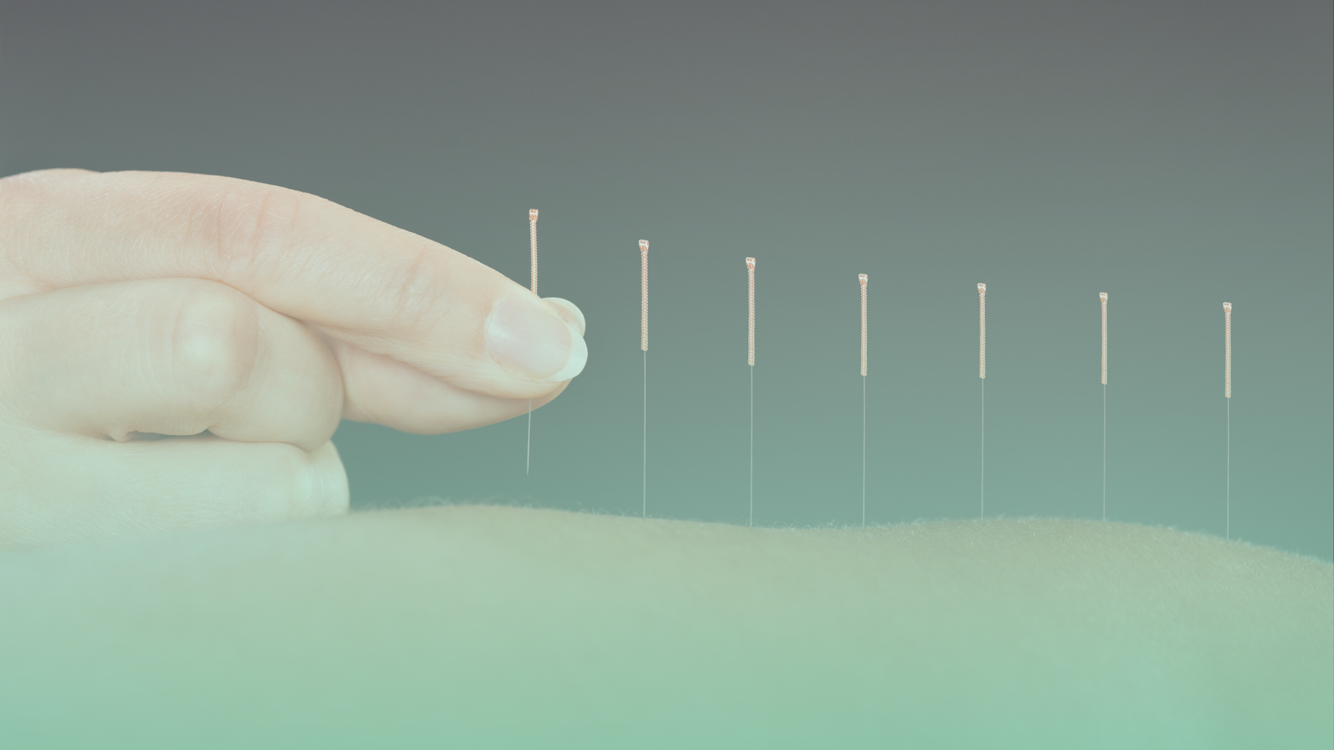 Acupuncture — Reboot