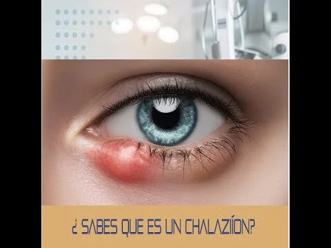 ¿Sabes que es un Chalazion? (Copy)