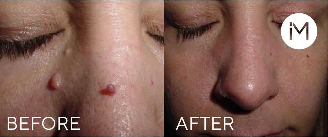 Cryopen Cryotherapy in Tarporley, Cheshire at Skinphinity aesthetics clinic