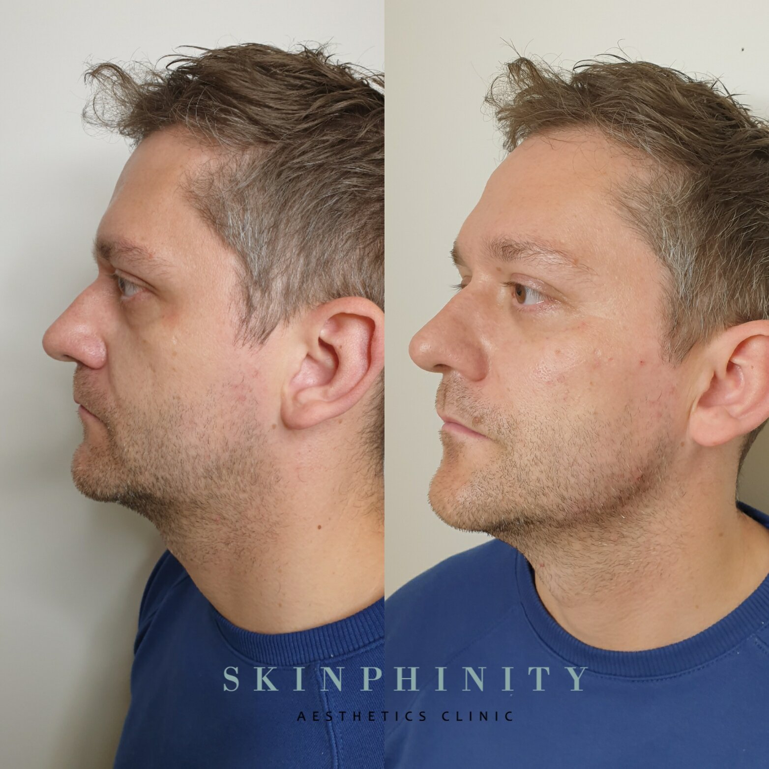 Cheek Treatments: A Useful Tweak and here’s how to Avoid a Disaster