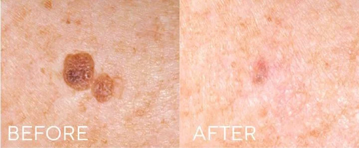 Cryopen Cryotherapy in Tarporley, Cheshire at Skinphinity aesthetics clinic