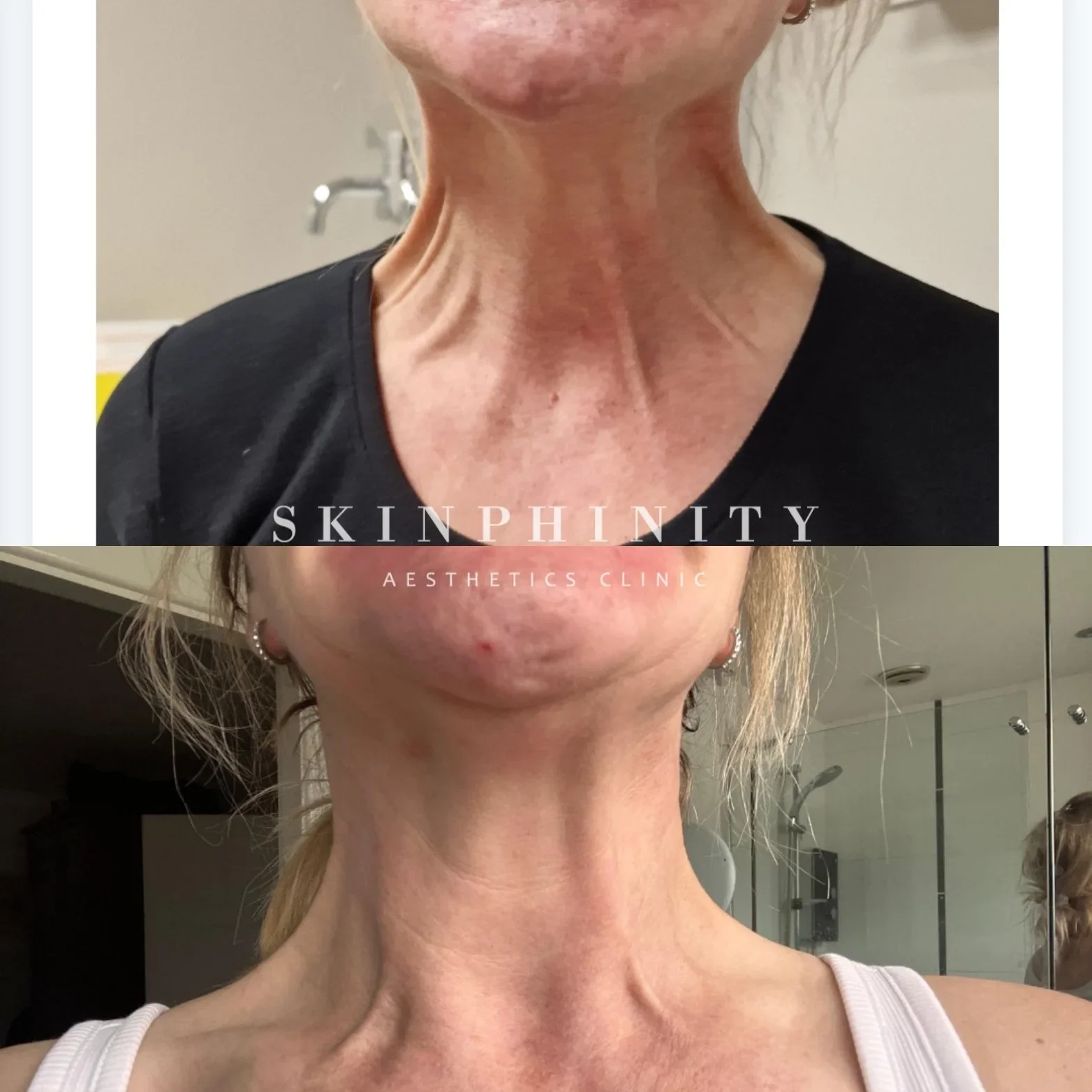 Neck_treatment_3_Skinphinity_Aesthetics_Tarporley_Cheshire.webp