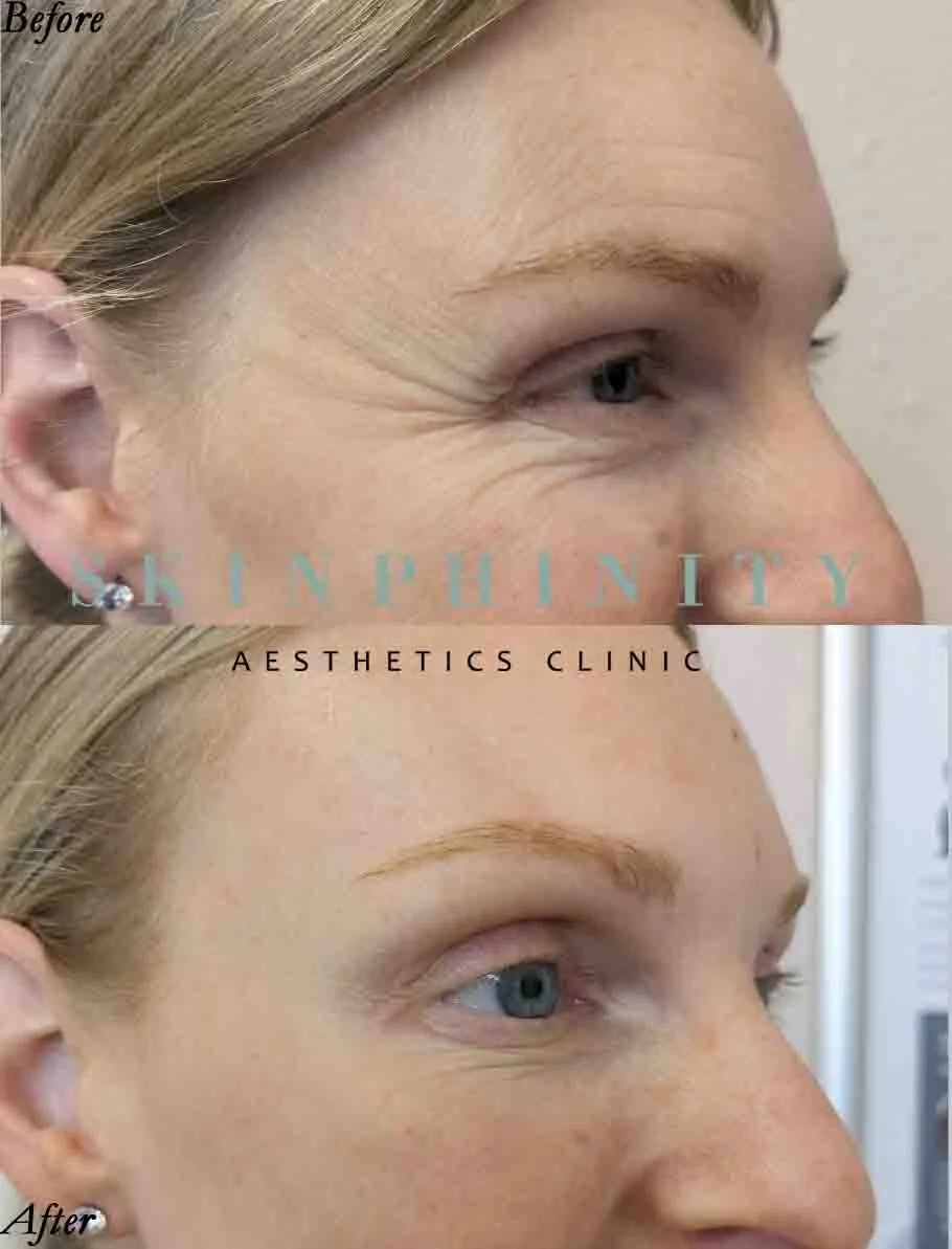 Botox used for a woman in her 30s wanting a refresh at Skinphinity in Tarporley, Cheshire
