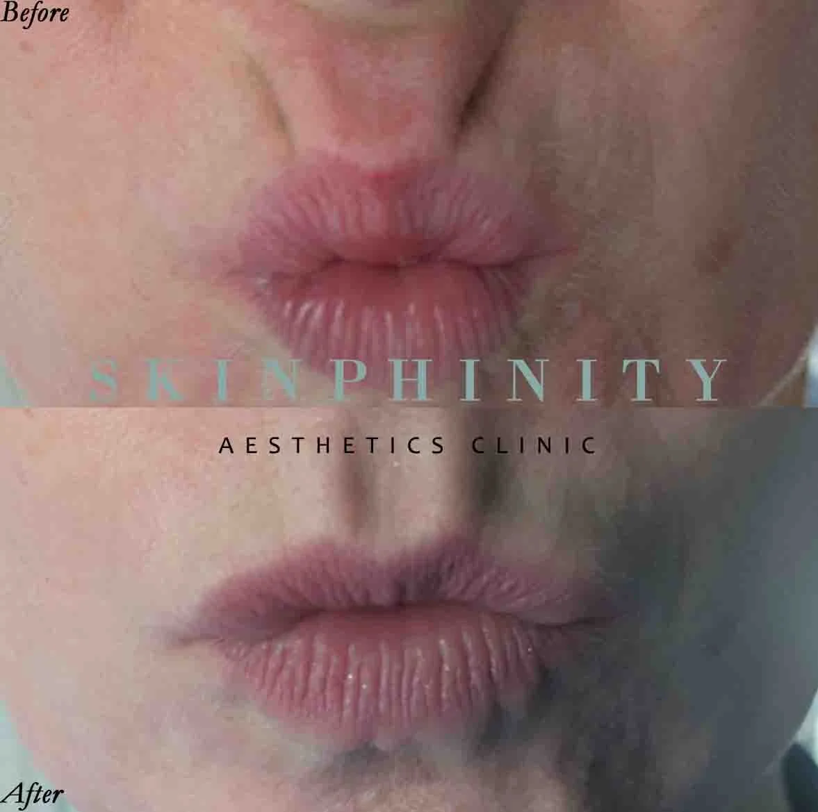 Botox in Tarporley, Cheshire at Skinphinity aesthetics clinic