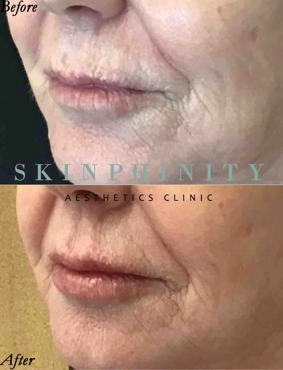Woman in her 60s had filler to address her worry that she had lost volume in her lips at Skinphinity in Tarporley, Cheshire