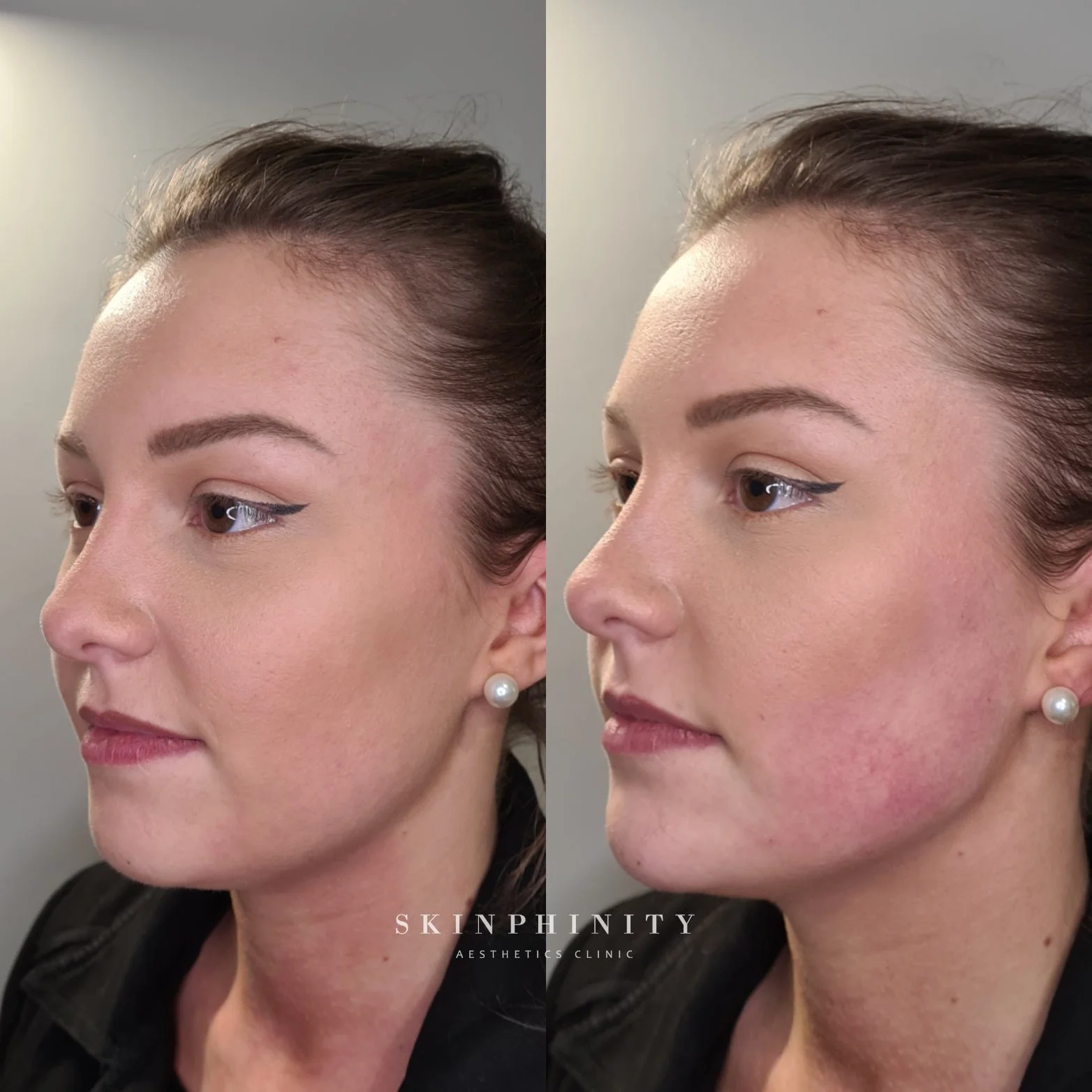 dermal filler Tarporley