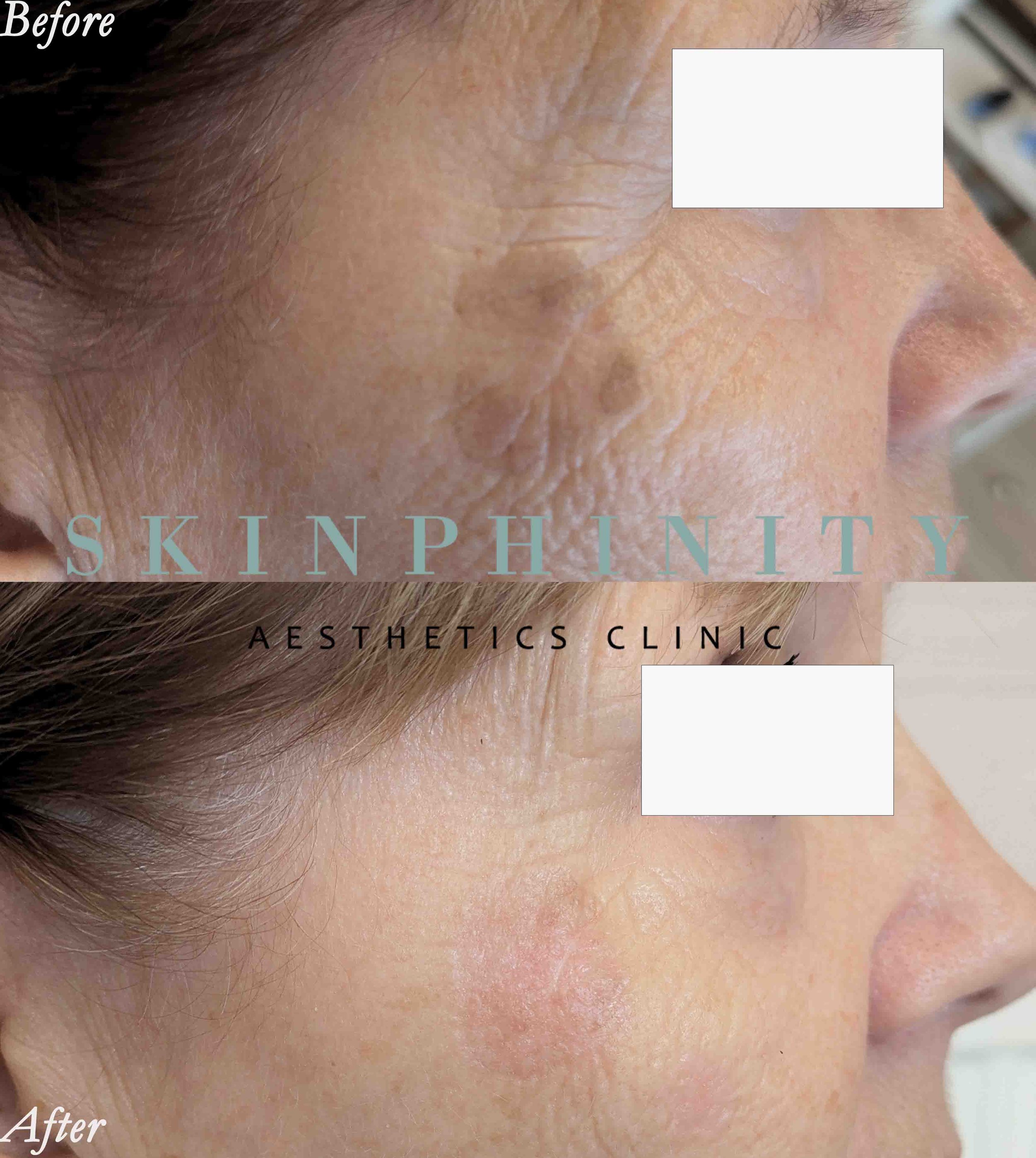 Cryopen Cryotherapy in Tarporley, Cheshire at Skinphinity aesthetics clinic