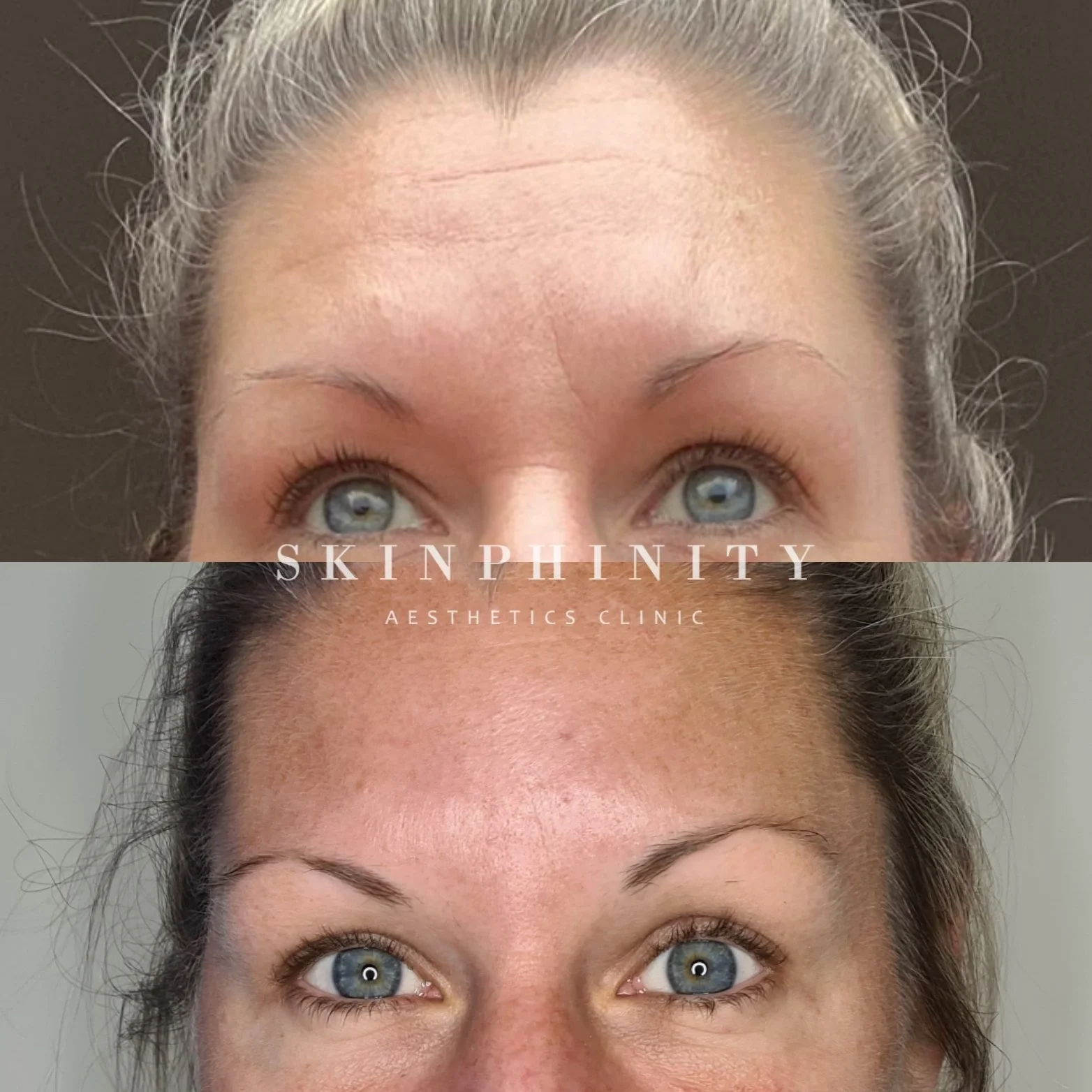 Botox in Tarporley, Cheshire at Skinphinity aesthetics clinic