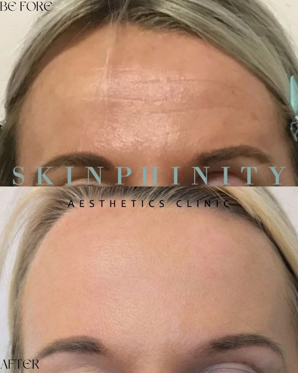 Both photos taken before Botox, 18 months apart having had 4 monthly treatments