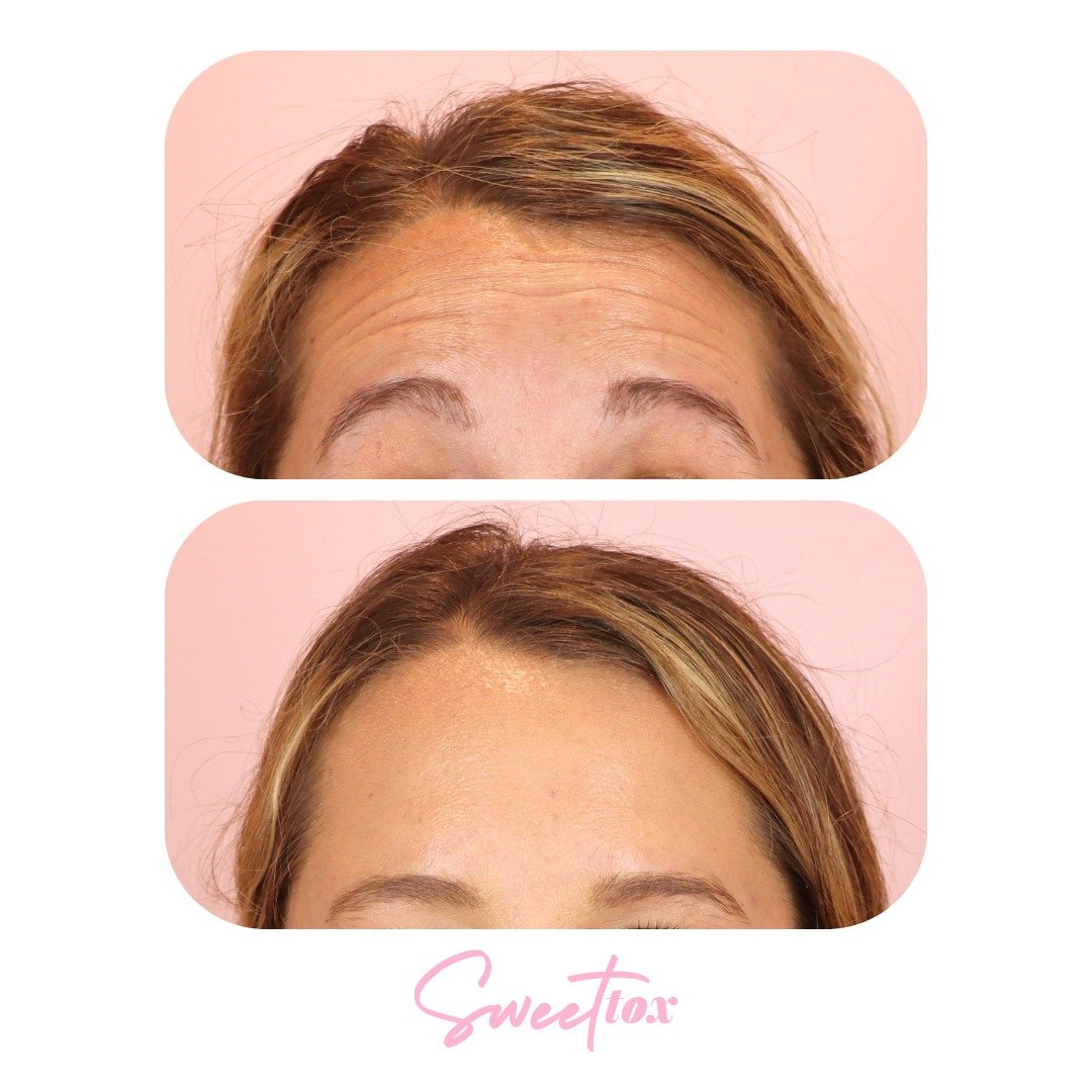 👋 Helloooo first-time tox flawless results! 🩷 

With just one session of Dysport (our fav tox product), we softened forehead lines for a natural, refreshed look. 

Effortless smoothness at the ready ✨