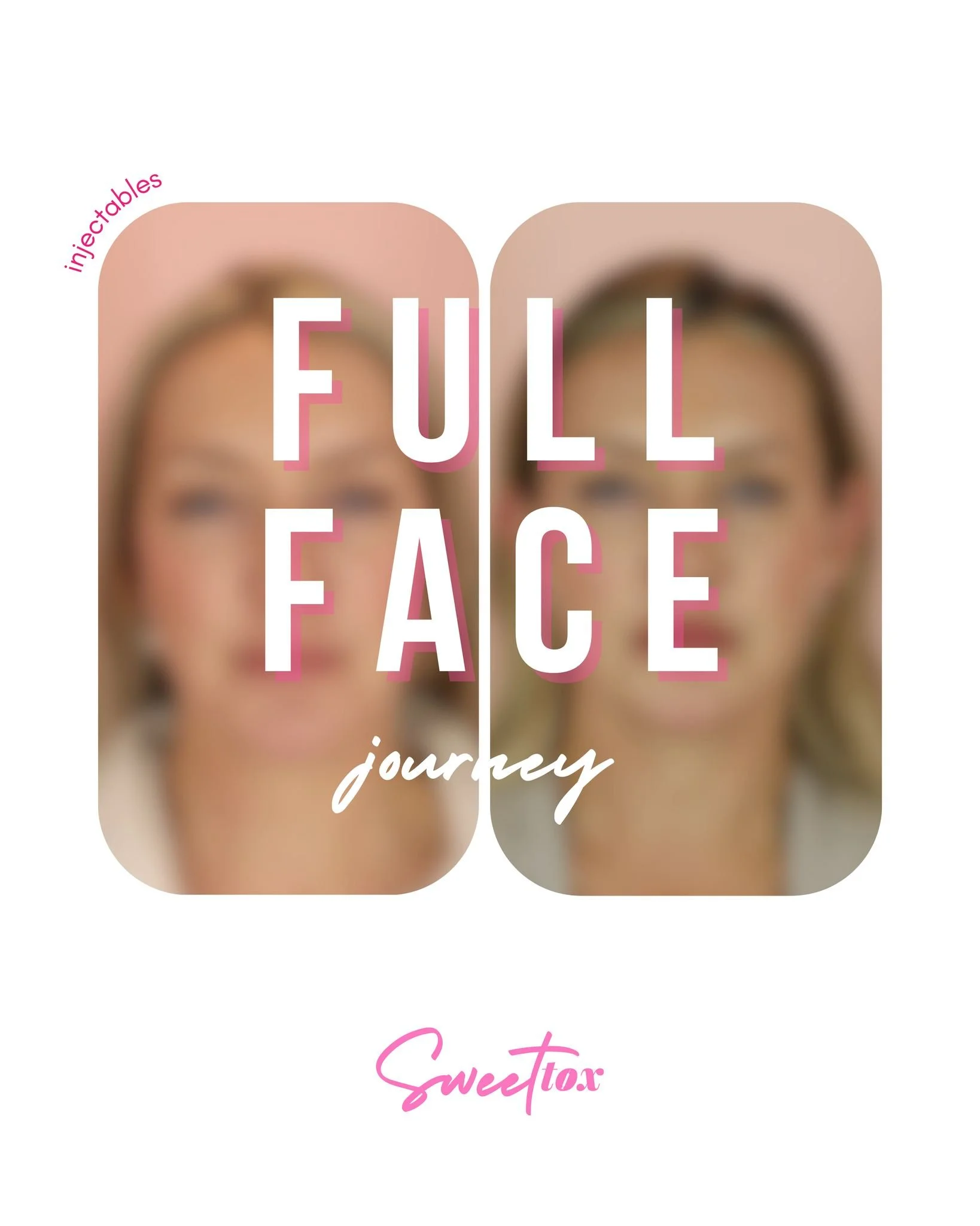 This beauty has been with us since 2024 and her transformation has been such a journey and even included getting her wedding ready! ✨💍

Here is a breakdown of what we have done: 

2024 was all about building her foundation 🧱

💉 Tox for smoothing +