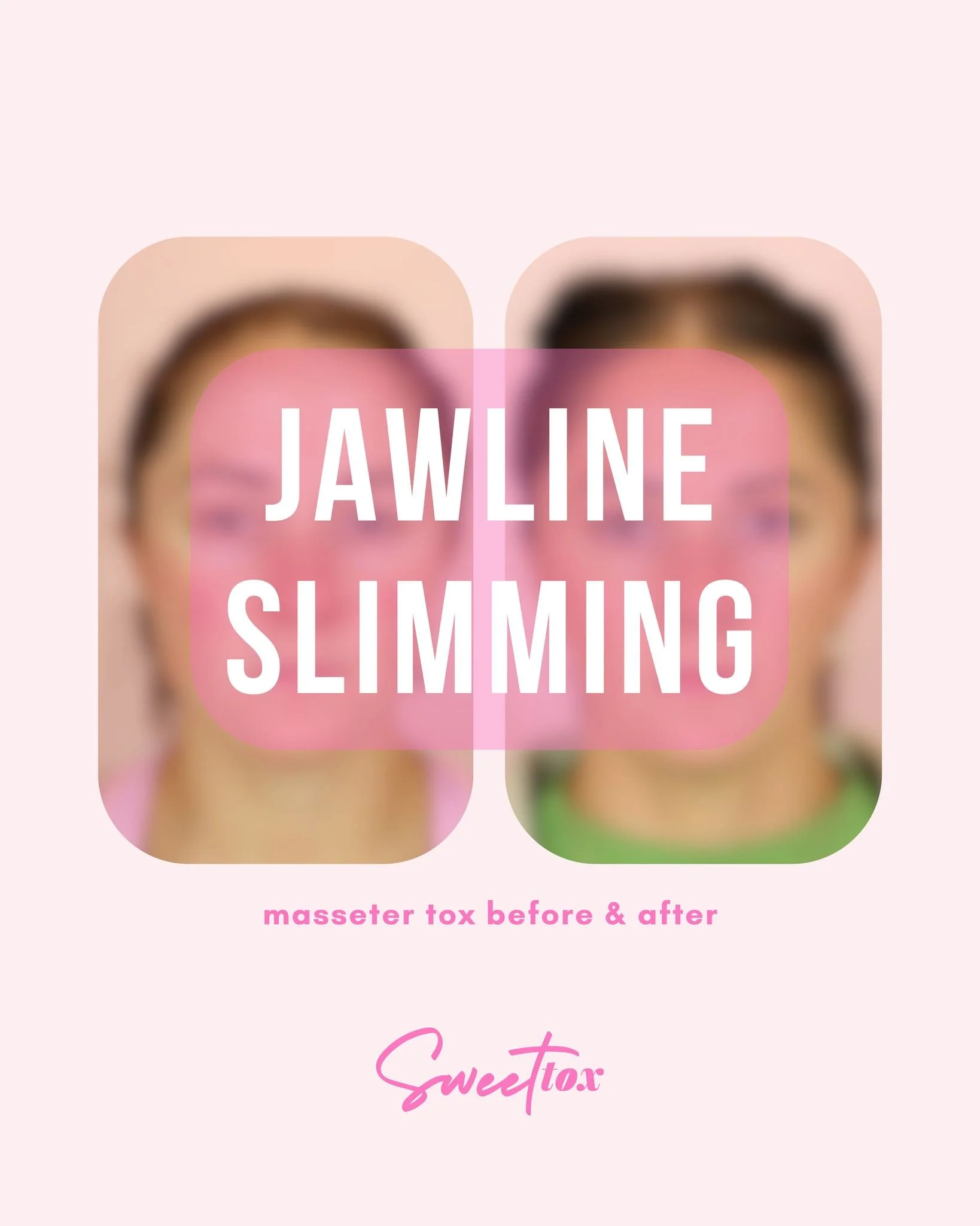 Did you know we can slim the jawline with tox? Well, now ya do! 💉
By injecting the masseter muscle with tox, not only can it slim your face, but it can also help clenching/TMJ symptoms. Win/win!
The masseter is the large muscle in your jaw that he
