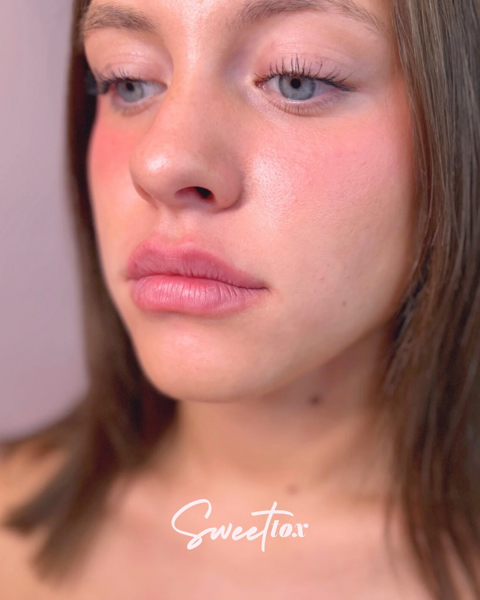 Pouty Perfect 👄 📸

We kicked off this beauty&rsquo;s injectable journey with a Mini Plump using Restylane Kysse- just enough to enhance her shape while keeping things soft and natural!

She drives quite a ways to see us (we adore her for that 💕), 