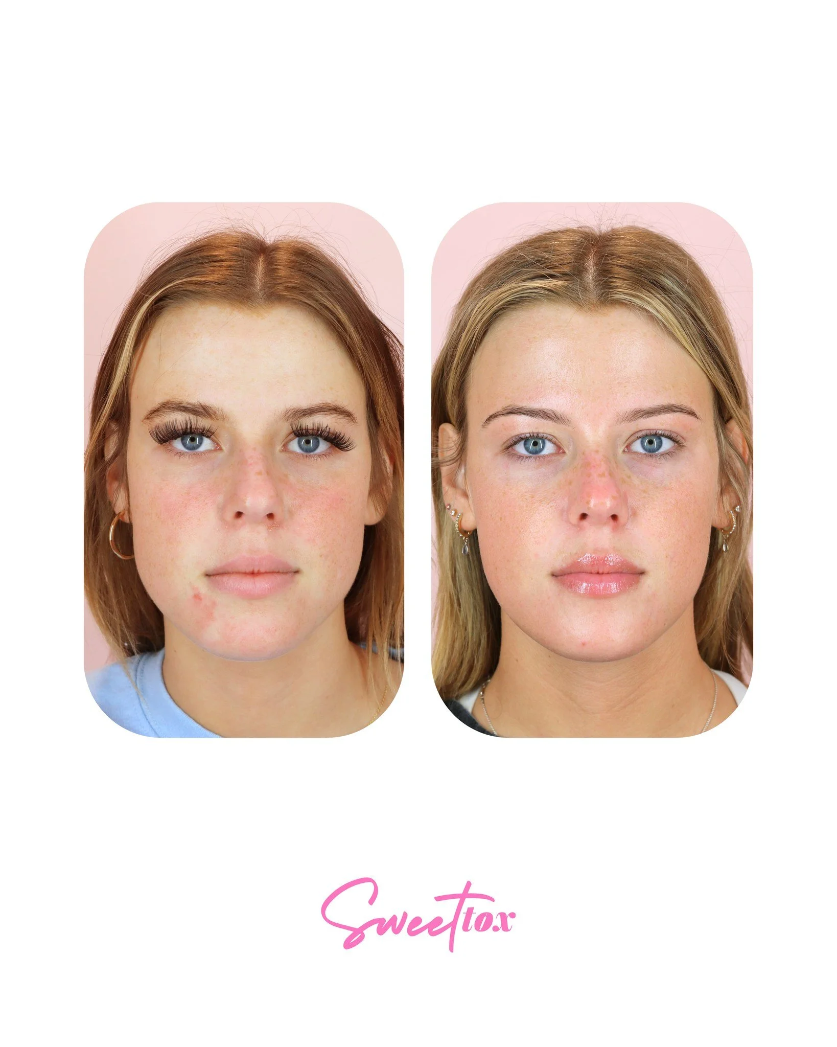 These results are 🔥🔥🔥!

Tox isn&rsquo;t just about aesthetics- it can also be life-changing for pain management! If you struggle with jaw clenching or tension, masseter tox might be exactly what you need. Not only did it help this patient find com