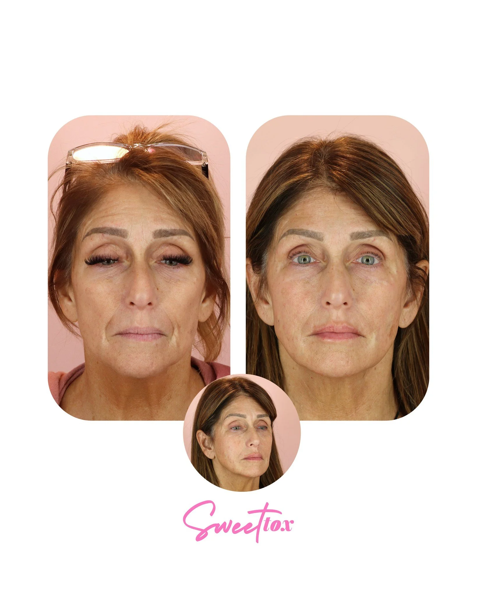 ✨ From December 2024 to today ✨

This patient came to us after trying treatments elsewhere and not feeling fully confident with her outcome. After a small consultation, together we created a customized plan that refreshed and balanced her natural fea