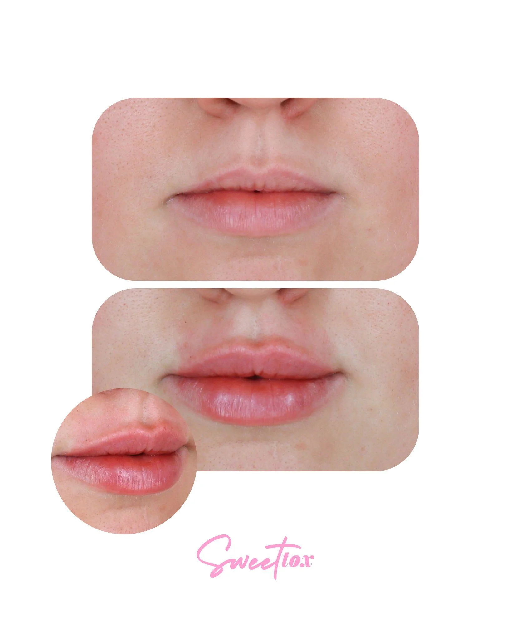 Natural &amp; soft, but still SO her 💕�

Her goal was a noticeable, yet not over dramatic enhancement that kept her natural lip shape front and center. She trusted our injector to choose the right amount for her, so we went with a Mini Plump (half s