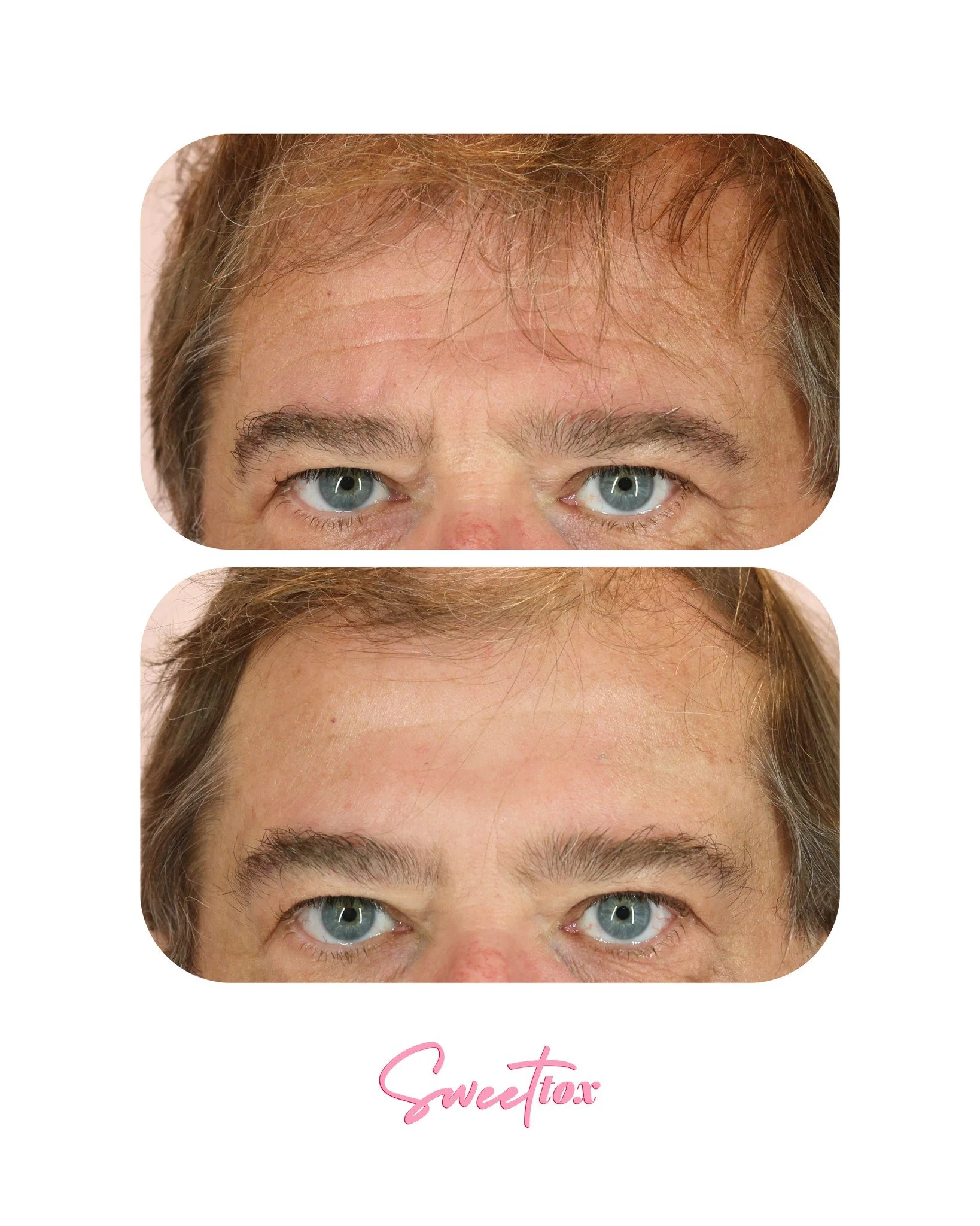 Hey friends, Emma here! 😊 I had to share these amazing before and afters and yes, they&rsquo;re of my dad! Can you believe it?!

He has always been very expressive, especially through his upper face. Over time, that constant muscle movement led to d