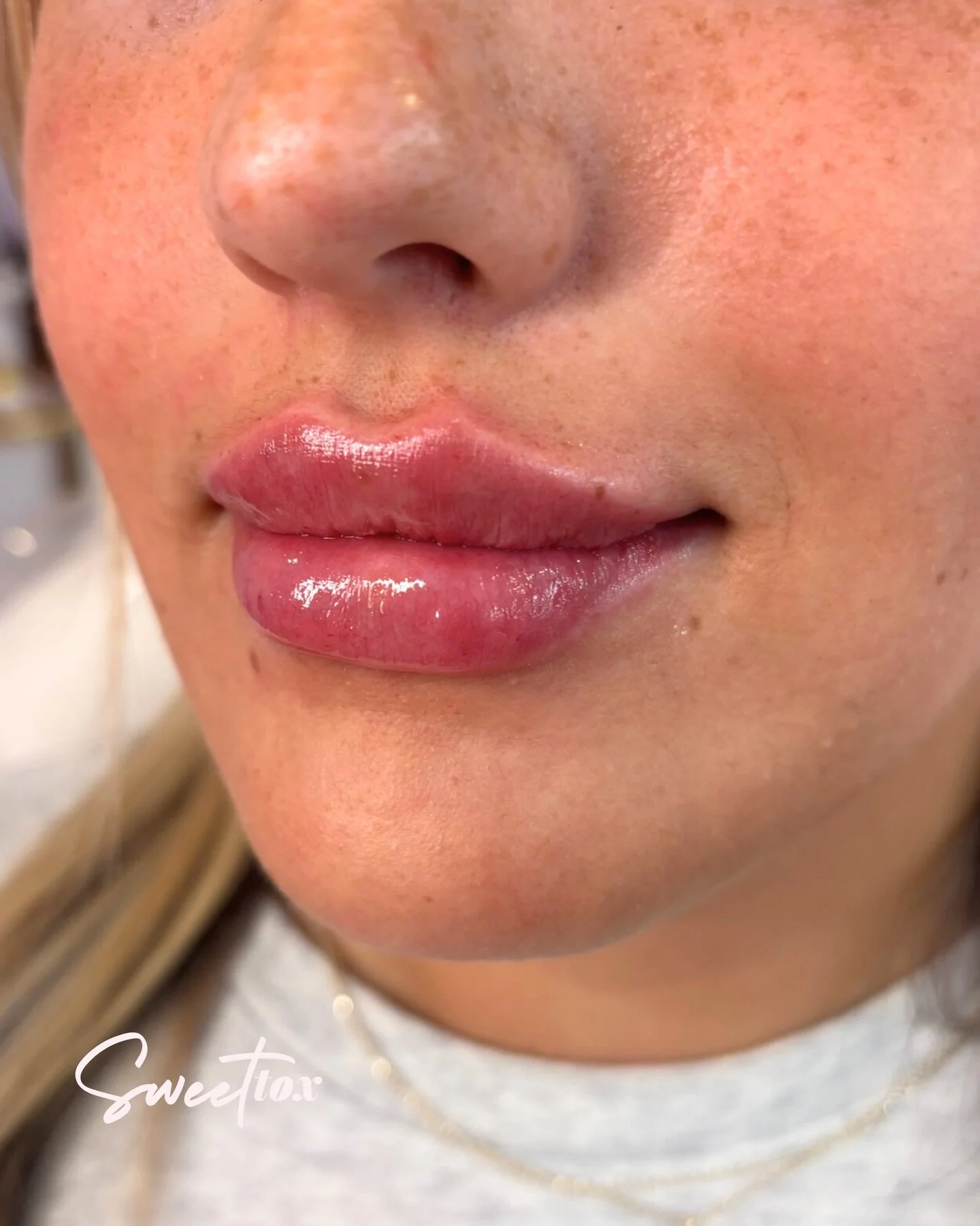 Even Picasso couldn&rsquo;t paint this 😮&zwj;💨 

#sweettox #lipfiller #filler #lipfillers