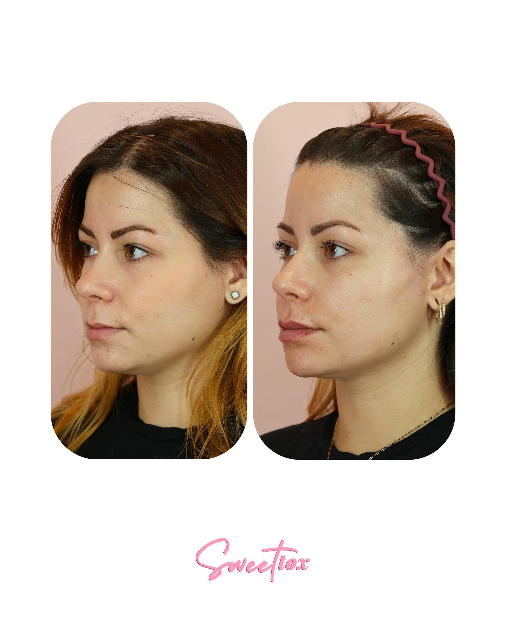 FACIAL BALANCING ⚖️

You&rsquo;ve heard us talking a lot about facial balancing lately&hellip; and that&rsquo;s because it&rsquo;s exactly what patients are asking for right now 🤍

For so long, filler had a reputation of being about making things bi