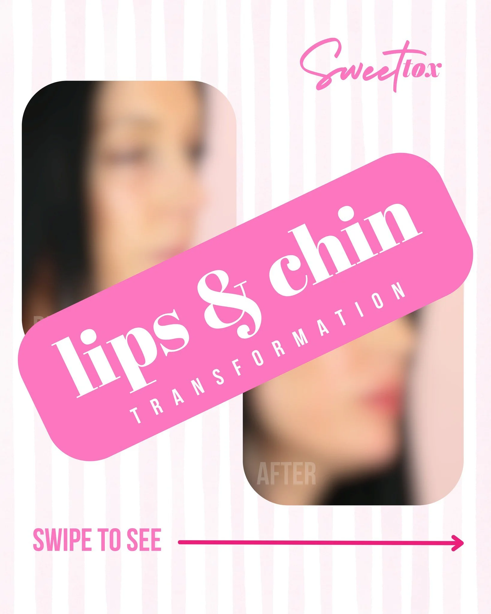 Sometimes...subtle treatments make the BIGGEST difference ✨

This beautiful patient came in for an appointment wanting to know what all could be done for subtle facial balancing! After doing a small consultation, we decided that a combination of tox 