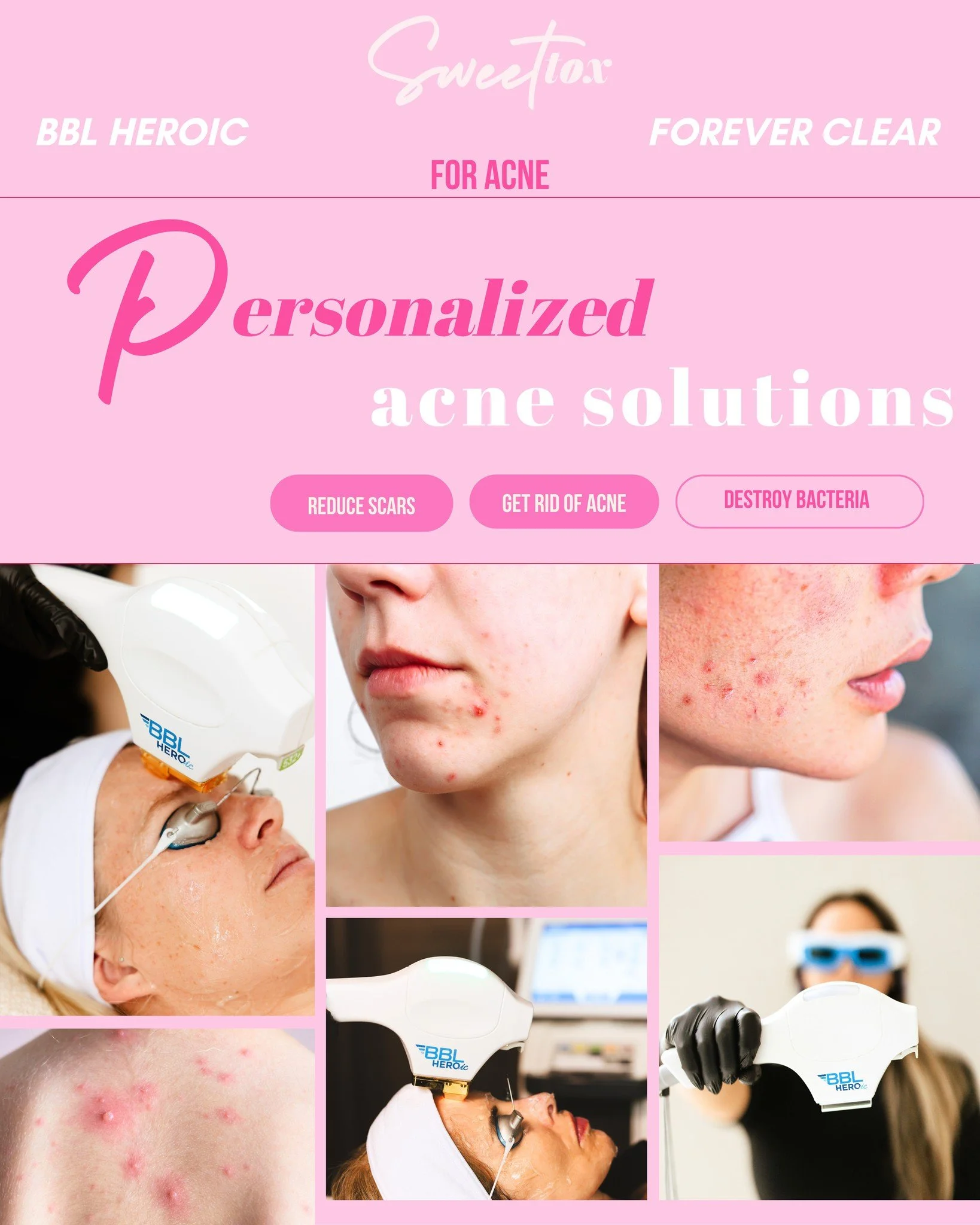 Real talk- dealing with active acne as an adult is so frustrating. Thankfully, we have a fix! 🛠️ Just call our aestheticians your new handywomen. 

BBL HEROic is one of our absolute favorite ways to get ahead of breakouts because it treats the surfa