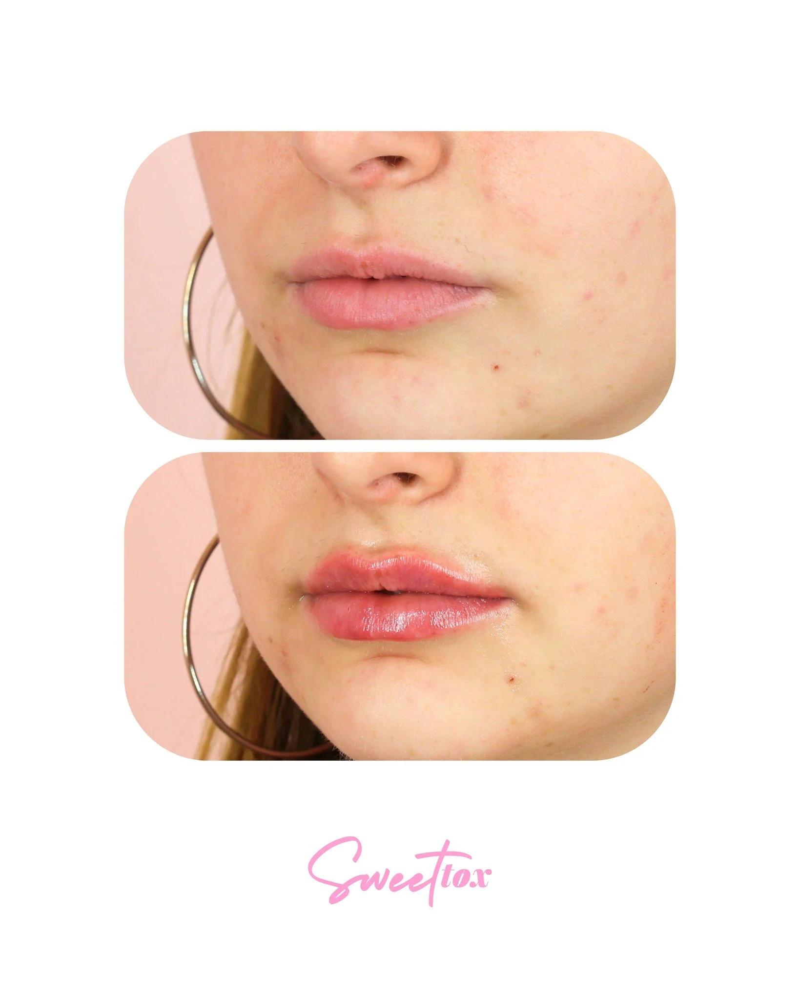 MINI PLUMP MADDNESS 🔥

Not every lip filler appointment needs a full syringe! While it's not a va-va-voooooooom transformation, sometimes the magic is in the half. Mini Plumps (aka half syringes) are often the sweet spot for patients who want to mai